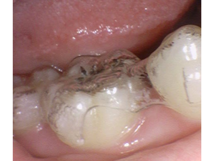 고덕동 투명교정은 발치 안 한다? 그건 오해입니다 관련 이미지 5