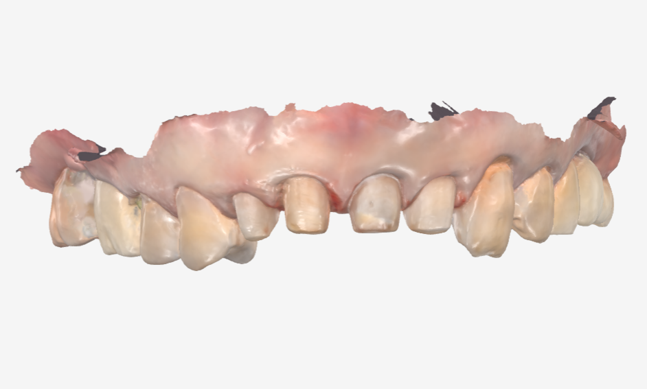 Gangdong-gu Dental Impressions: Are You Still Biting Down for 5 Minutes? We’ll Make It Comfortable with an Intraoral Scanner! image 11