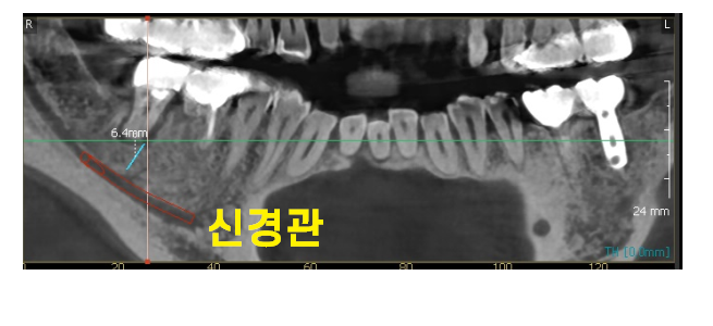 치아뿌리 염증 통증 유무 상관없이 치료를 받아야하는 이유 관련 이미지 5