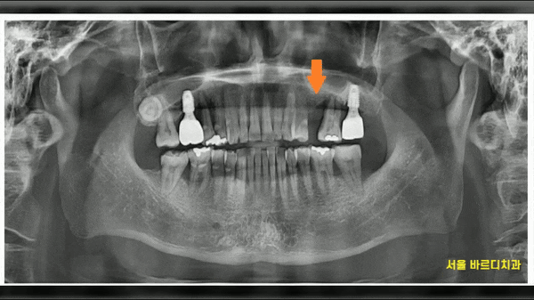 상일동 치과 잇몸 내려감 치료는 임플란트로 관련 이미지 1