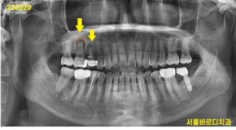 고덕동 치과 잇몸 주저앉음 느낌이 들었다면 늦었을 수도 있습니다. 관련 이미지 3