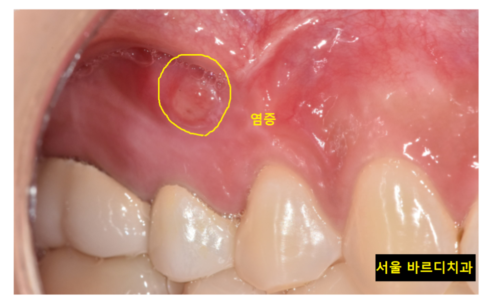망월동 치과 재신경치료 자연치아 살리기 끝판왕 치료 mta로 가능했습니다. 관련 이미지 4