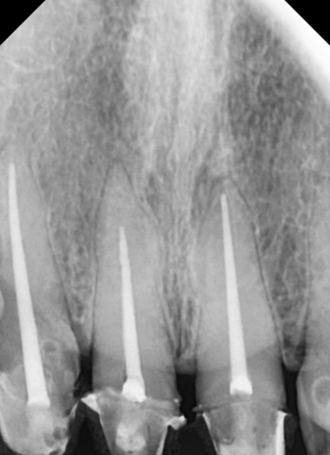고덕동 심미 보철, 삐뚤어진 앞니, 교정 없이 바로잡은 비결 관련 이미지 9