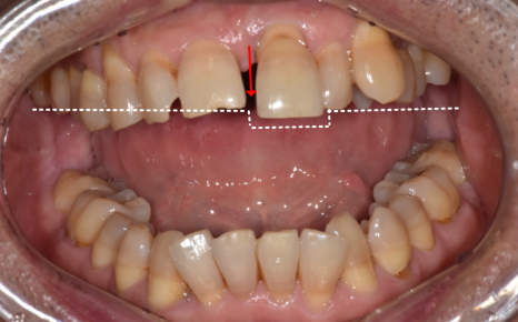 잇몸 내려감으로 길어진 치아, 방치하면 안 되는 원인, 증상, 이유 관련 이미지 5
