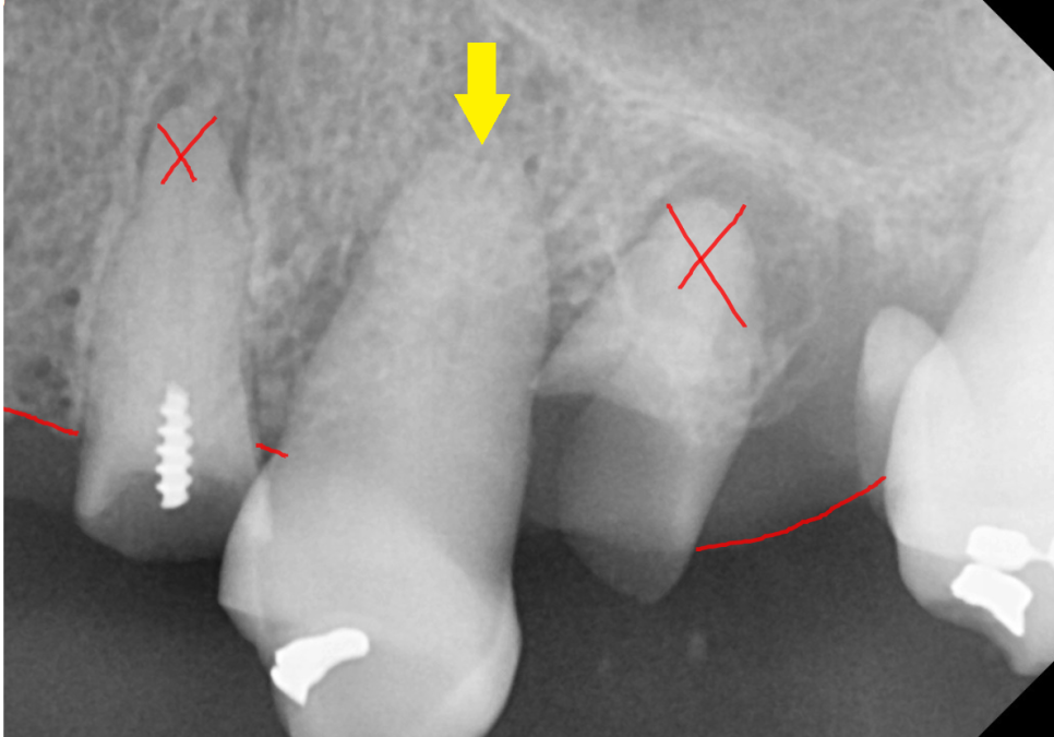 전체적인 치아 치료 13개의 임플란트를 식립한 환자분 관련 이미지 6