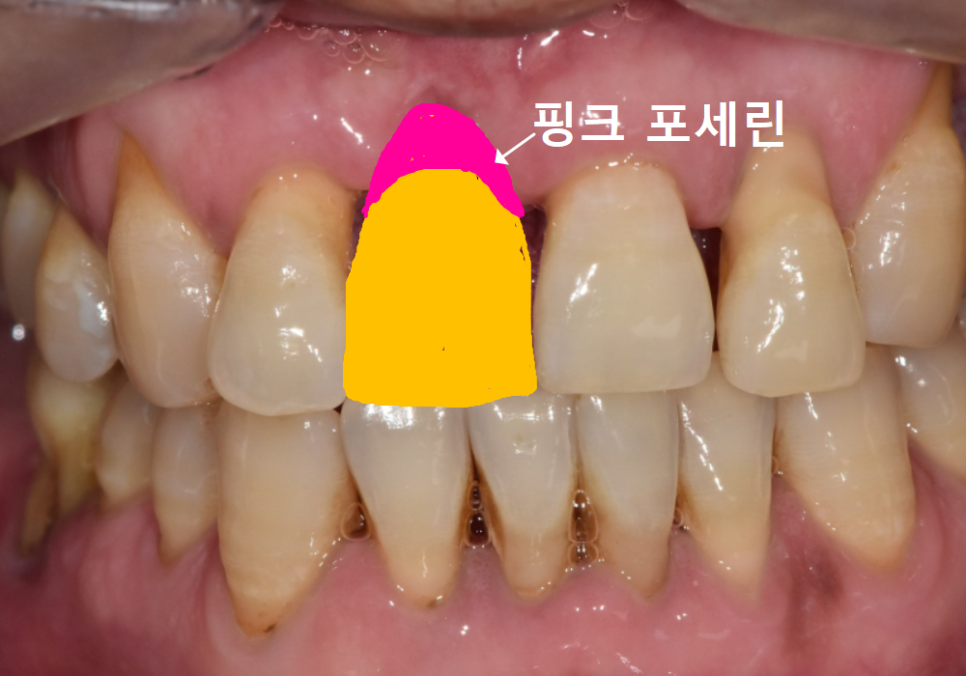 앞니 잇몸 꺼짐, 잇몸 이식 없이도 임플란트 할 수 있는 방법 공개합니다. 관련 이미지 13