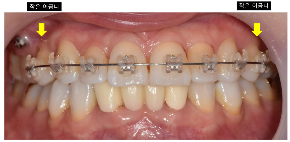 Solved My Concerns About Protruding Front Teeth with Partial Re-orthodontic Treatment of the Front Teeth image 6