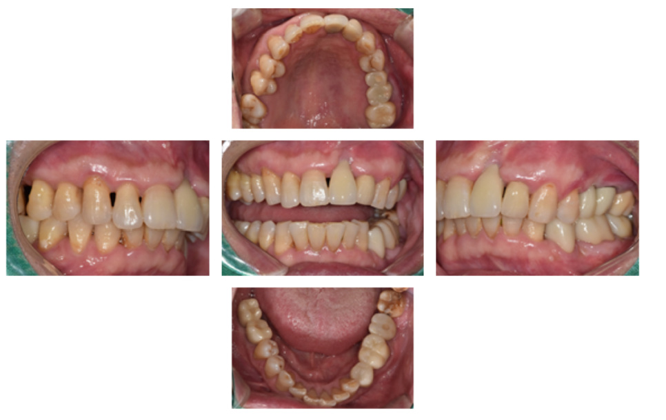 고덕동치과 서울바르디치과 전치부 및 구치부 임플란트 치료증례 #9 관련 이미지 37