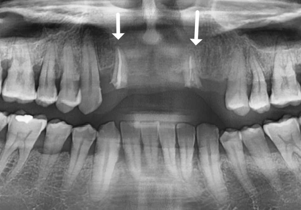앞니 브릿지 부러짐, 이런 상태라면 절대 브릿지 다시 하지 마세요. 관련 이미지 6