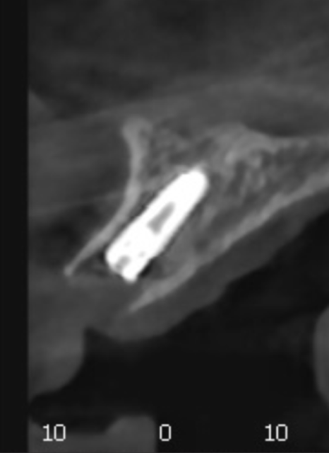 대문니 빠짐, 앞니 빠졌을 때 브릿지와 임플란트 중 나에게 맞는 선택은? 관련 이미지 11