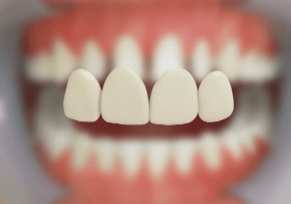 무삭제 라미네이트 적응증, 당신이 미처 몰랐던 시술의 조건을 공개합니다. 관련 이미지 2