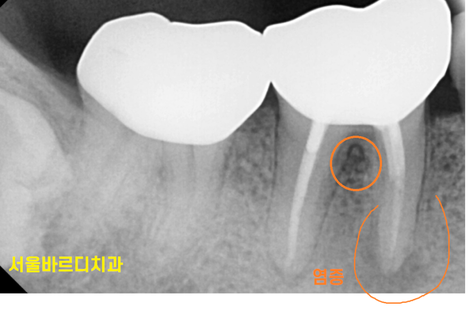 잇몸 물집 강일역 치과에서 원인 알아보고 임플란트로 치료했습니다. 관련 이미지 3