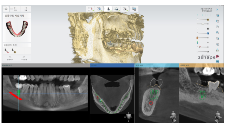 서울 네비게이션 임플란트 치과 불안할 때 좋은 선택지가 될 수 있습니다. 관련 이미지 5