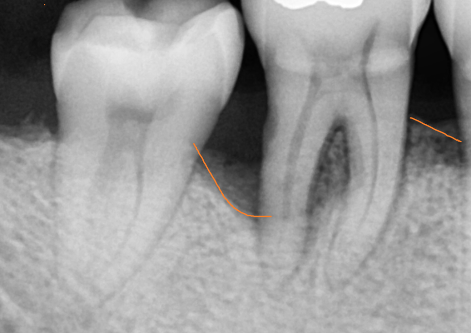 상일동 치과 잇몸 내려감 치료는 임플란트로 관련 이미지 6