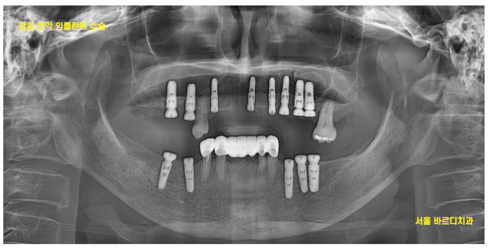 암사동 치과 전악 임플란트 하루만에 끝냈습니다. 관련 이미지 10