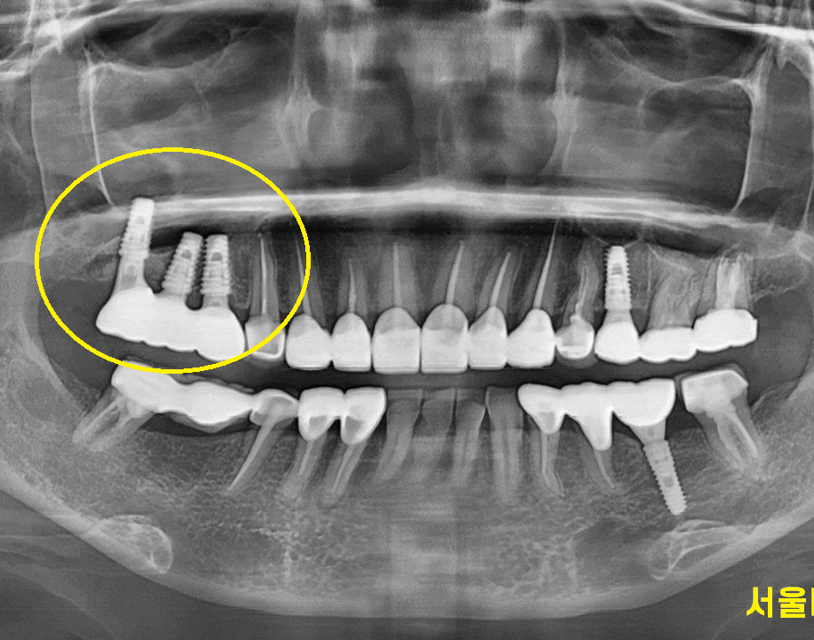 보철 부러짐 발생으로 치아 뿌리만 남았을 때 치료 방법 임플란트 관련 이미지 1