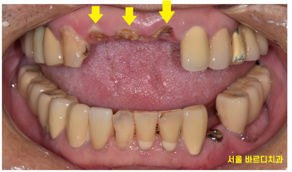 상일동역 치과 부러진 앞니 임플란트로 복구하기 프로젝트 관련 이미지 2