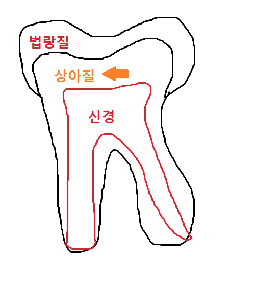 어금니 금감 발치 후 임플란트 풍산동 치과에서 진행했습니다. 관련 이미지 4