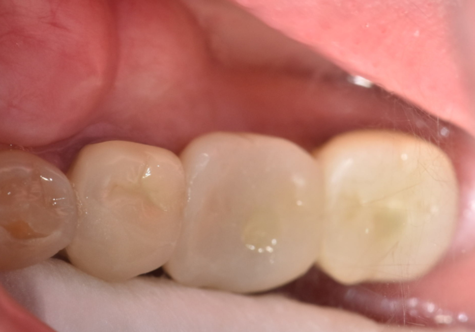 애써 심어둔 임플란트, 교체해야 된다구요? 냄새가 난다면 확인해보세요. 관련 이미지 15