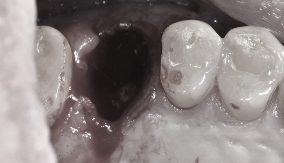 망월동 치과 염증이 심하면 임플란트 바로 못심어요 잇몸뼈 함몰 케이스 관련 이미지 6