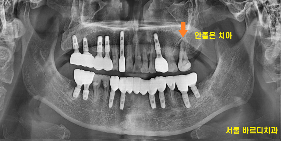 녹아버린 잇몸뼈 흔들리는 여러 치아 발치 후 임플란트 시행 관련 이미지 9