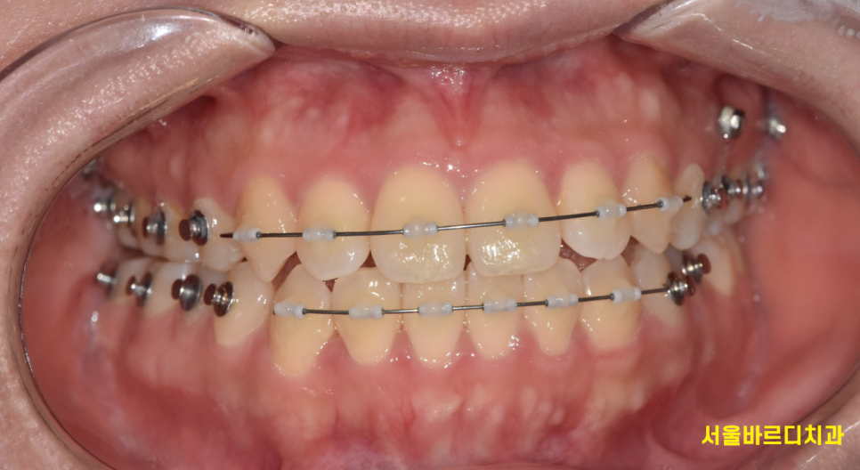 강일동 치아교정 과정 시작부터 마무리까지 알려드려요! 관련 이미지 3