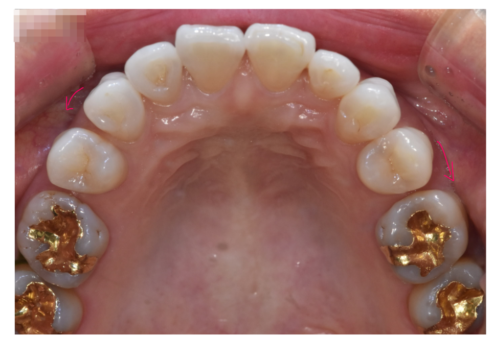 Solved My Concerns About Protruding Front Teeth with Partial Re-orthodontic Treatment of the Front Teeth image 5