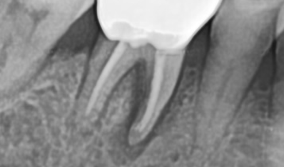 바르디 임플란트는 바르게 심지만, 빠르게 씹습니다. 그간의 경험을 바탕으로요. 관련 이미지 11
