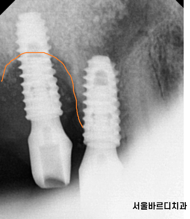 둔촌동 치과 임플란트 평균 수명 이것이 진짜 진실입니다 관련 이미지 6