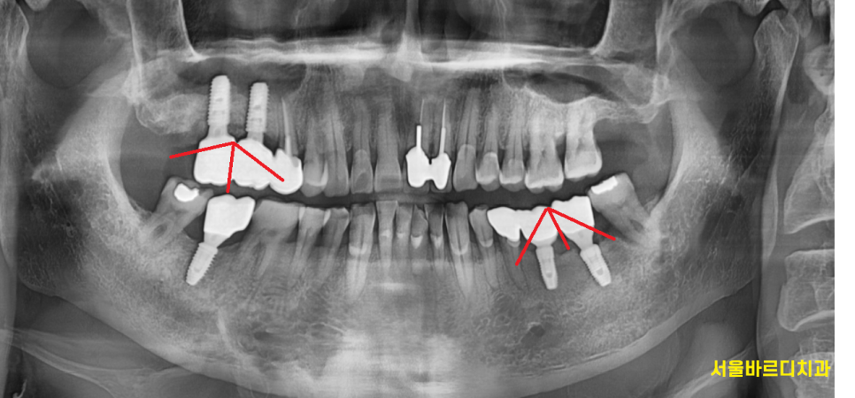 고덕동 임플란트 크라운 연결해서 만드는 이유는? 관련 이미지 6
