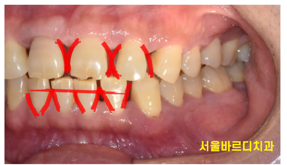 앞니 사이 간격 넓어짐 치아가 벌어져서 보기 싫을 때 크라운 치료 관련 이미지 6