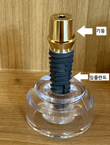 임플란트 기둥 맞춤으로 어느 한 과정도 놓칠 수 없으니까! 관련 이미지 3
