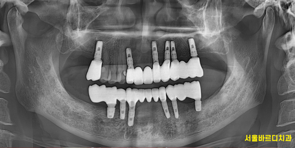 앞니 어금니 임플란트 동시에 진행할때 순서는? 관련 이미지 6