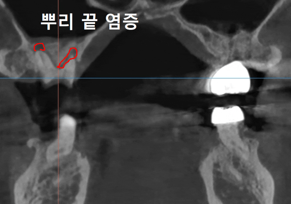 상일역 치과, 오래된 금니 빠짐, 같은 증상으로 내원했지만 전혀 다른 결과, 그 차이는? 관련 이미지 6