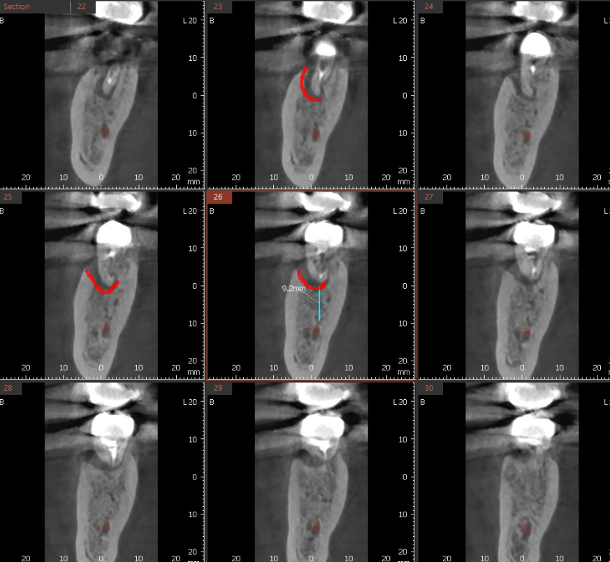 치아뿌리 염증 통증 유무 상관없이 치료를 받아야하는 이유 관련 이미지 4