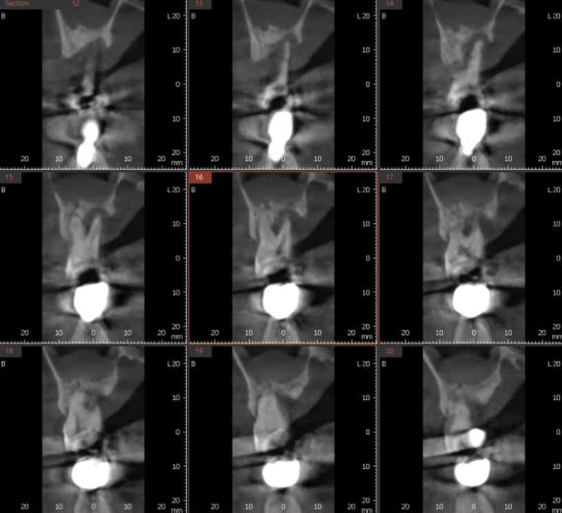 상일동 임플란트 치아 솟음으로 불편함을 느낄 때 관련 이미지 5