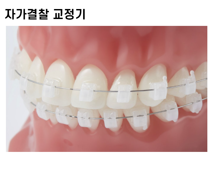 치아 교정기 종류 결정장애 환자분들을 위한 친절한 설명서 관련 이미지 5