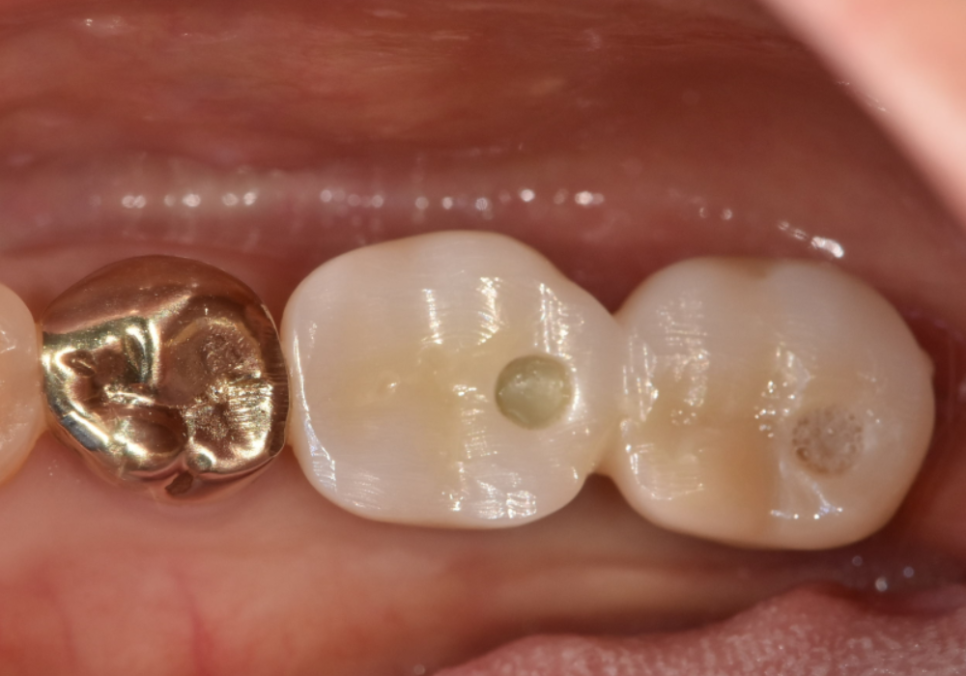 천호동 임플란트 재식립 사례, 평생 쓰는 줄 알았는데? 관련 이미지 14