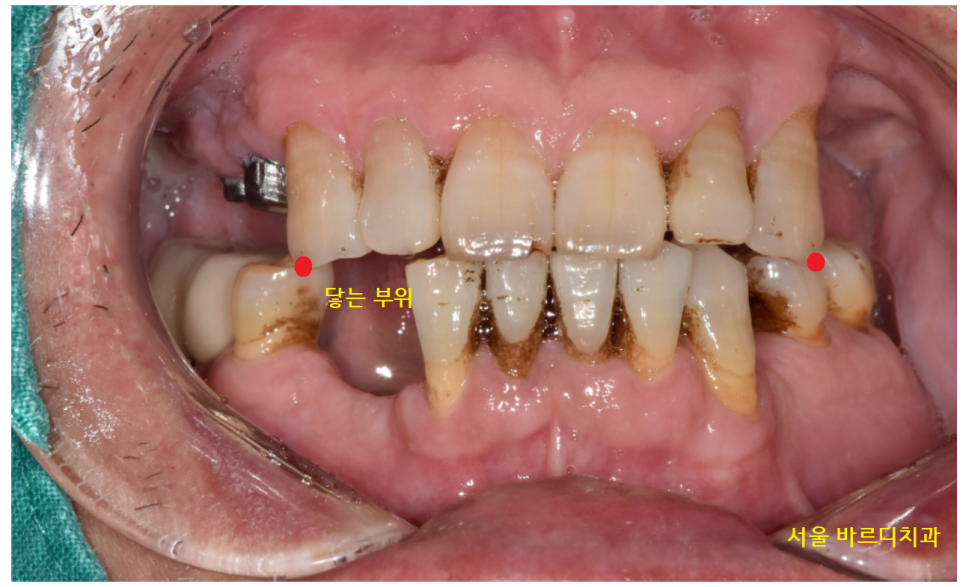 하남시청치과 디지털 임플란트를 고집하는 이유 관련 이미지 3