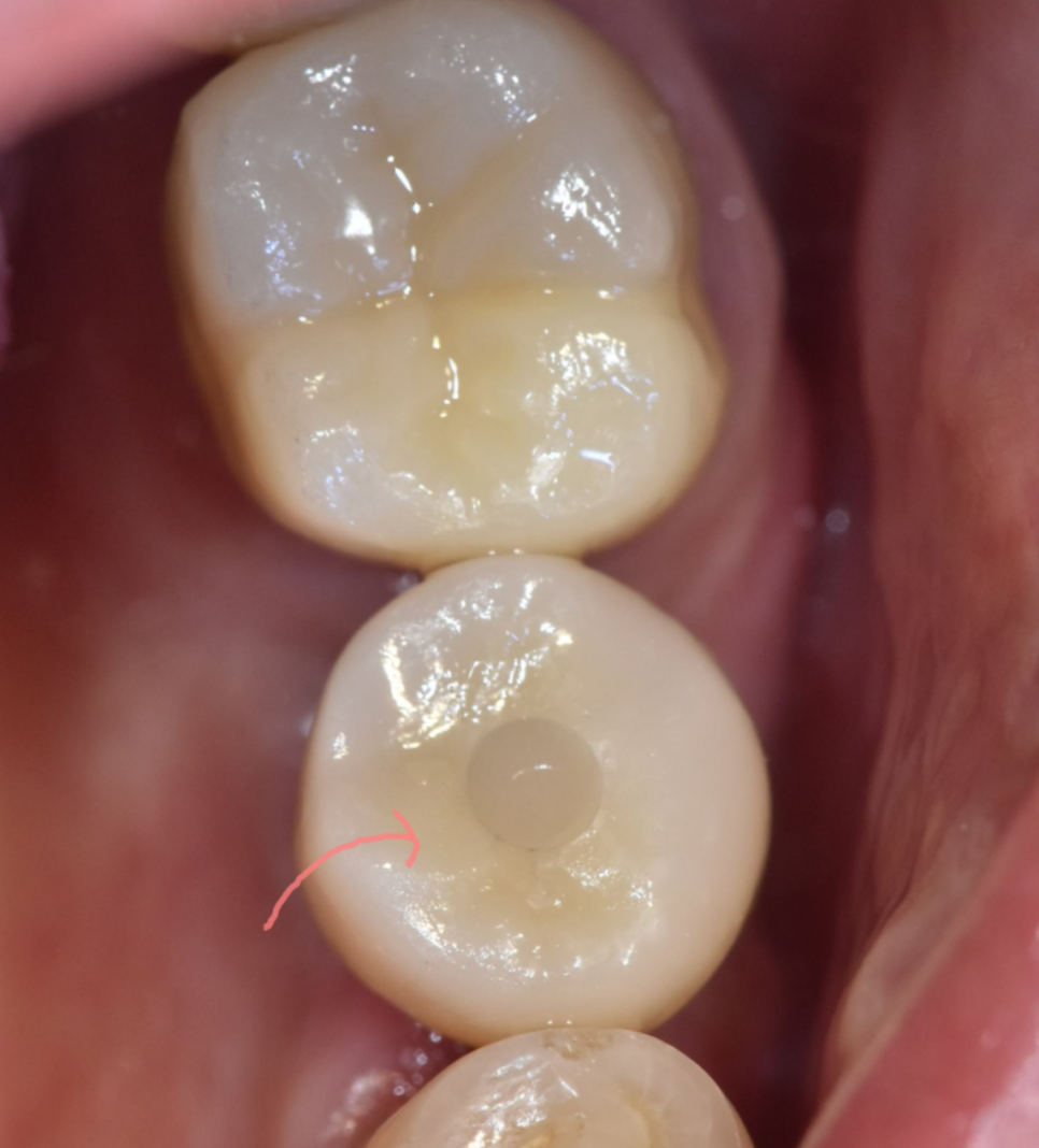 임플란트 시술 과정 총정리했습니다. 간접 경험 해볼까요? 관련 이미지 6