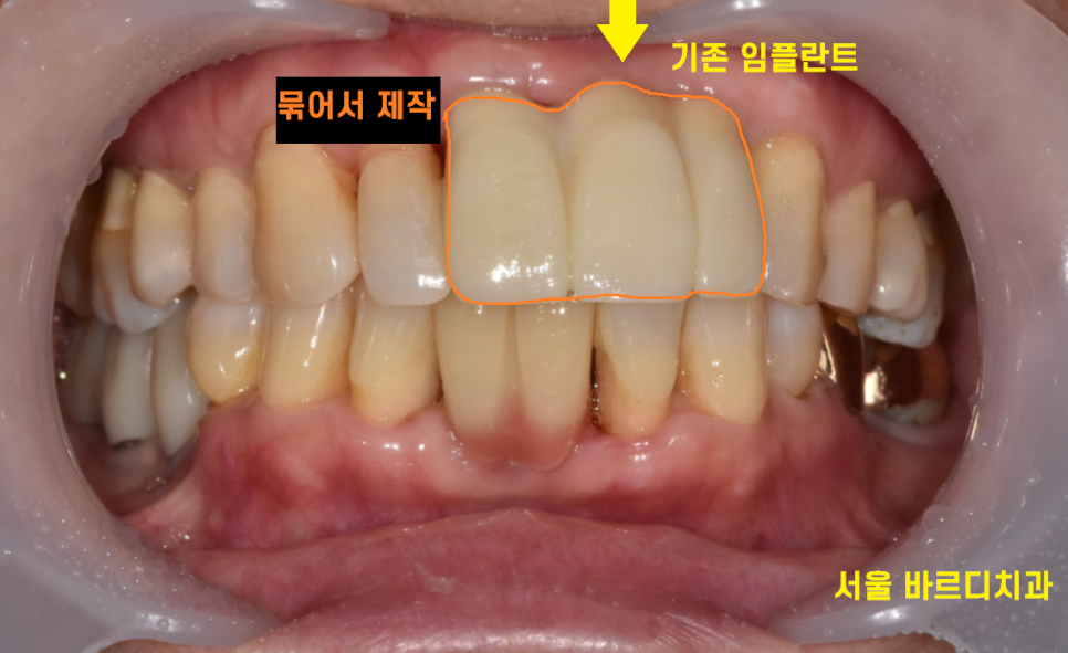 미사 임플란트 보철 새로하고 연결했습니다. 관련 이미지 10