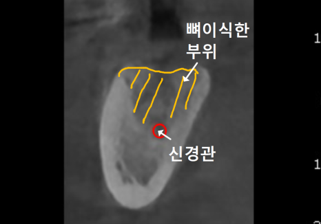어금니 구멍, 충치 솔직하게 말씀드립니다. 치과 공포증으로 미루신 분들 필독 관련 이미지 10
