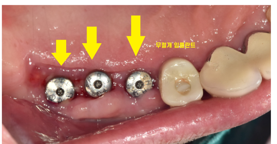 천호동 치과 무절개 임플란트 비교하고 결정하세요 관련 이미지 3