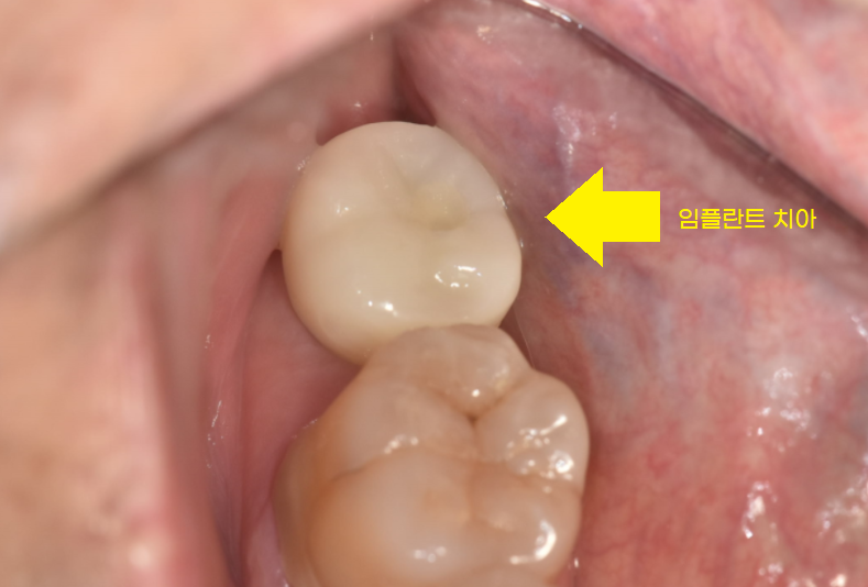 덕풍동 치과 잇몸 욱신 욱신 원인 찾아 임플란트 수술하였습니다. 관련 이미지 10
