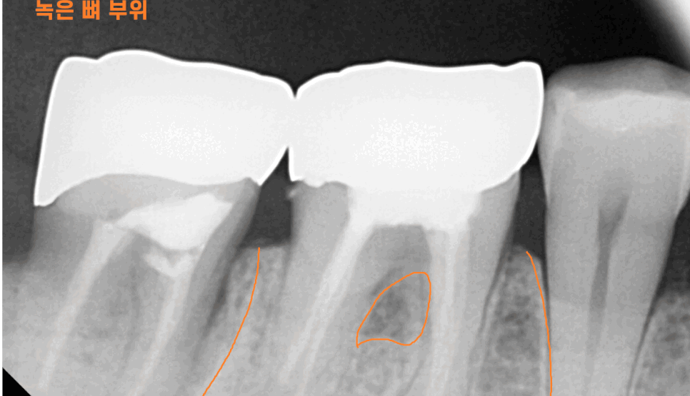 치아뿌리 염증 통증 유무 상관없이 치료를 받아야하는 이유 관련 이미지 1