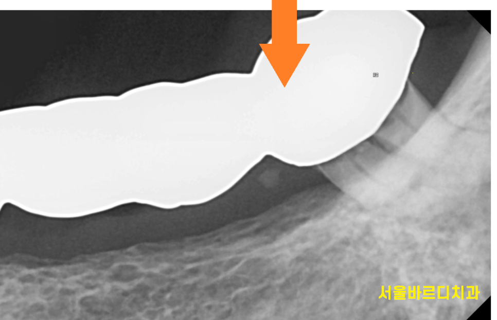 하남 임플란트 치과 주문진에서부터 치료 받으러 오신 환자분 관련 이미지 4