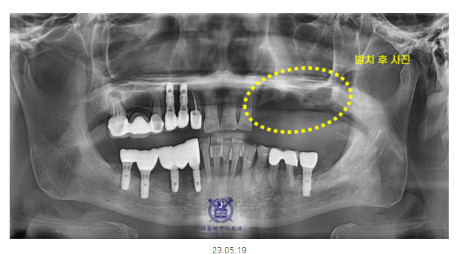 미사 임플란트 70대 연령과 상관없는 치료 과정 관련 이미지 6