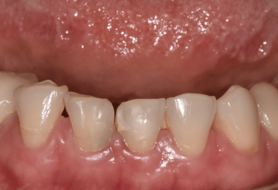 앞니 레진 떨어짐, 자꾸 반복된다면 관련 이미지 2