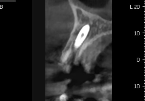 아스피린 복용 중인데 임플란트 수술, 가능할까요? 아스피린 얼마나 끊어야 하나요? 관련 이미지 8