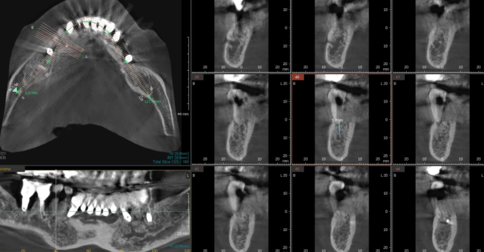 덕소 치과 발치 후 당일 뼈이식의 중요성 설명드립니다!! 관련 이미지 6